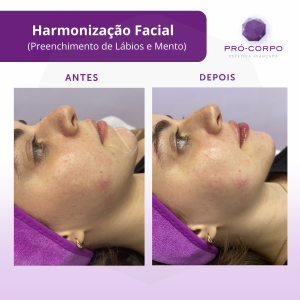 Harmonização Facial
